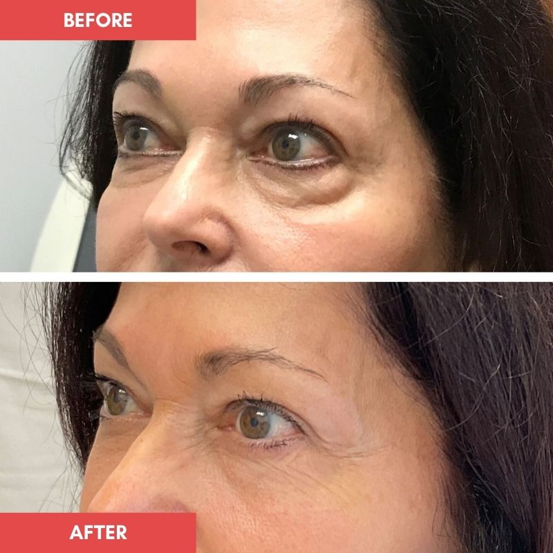Under Eye Red Light Therapy Wrap