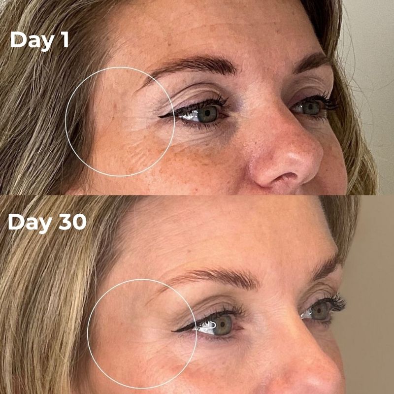 Under Eye Red Light Therapy Device