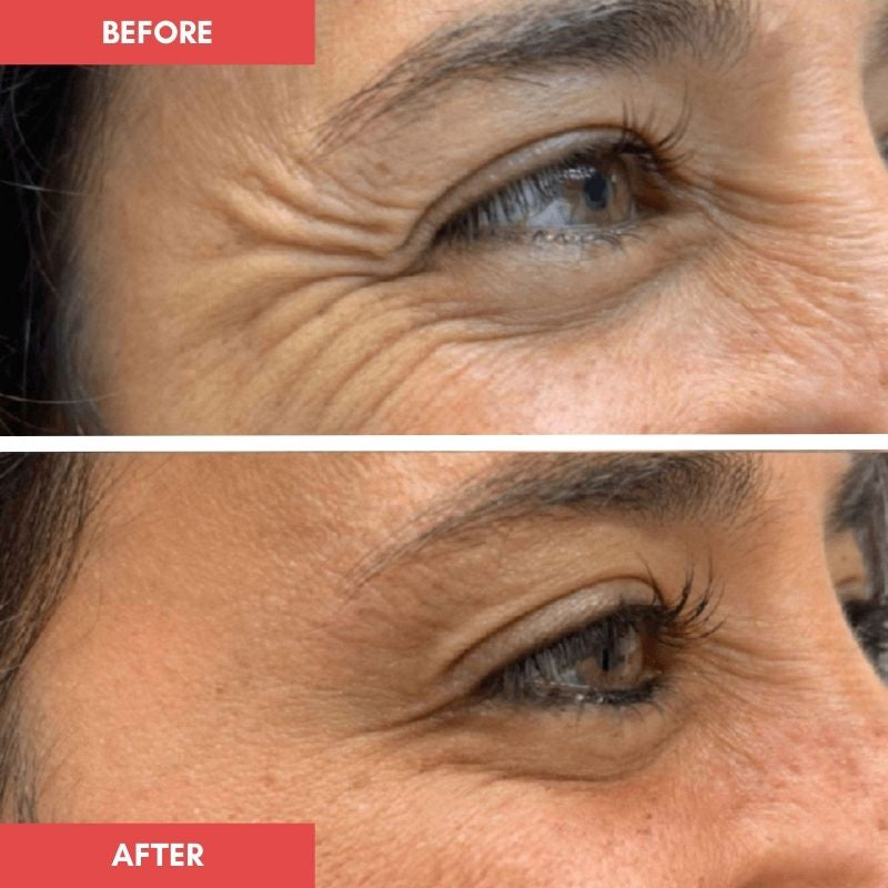 Under Eye Red Light Therapy Wrap
