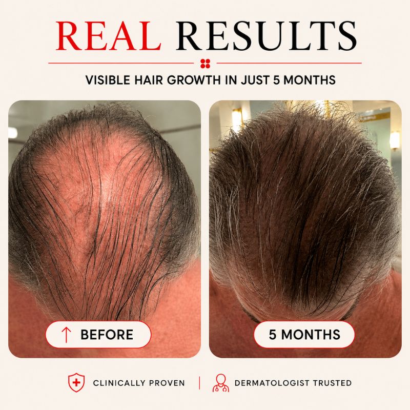 Laser Hair Growth Helmet With 176 Lasers